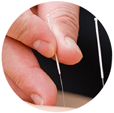 Acupuncture